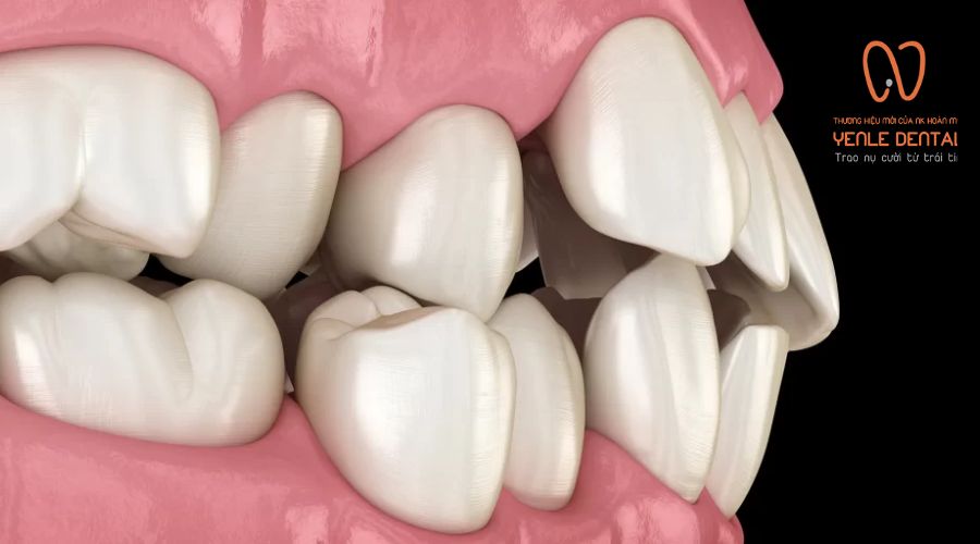 chỉnh răng mọc lệch